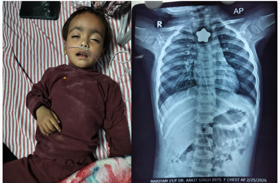 Magnet stuck in girl's food pipe, doctors save her life