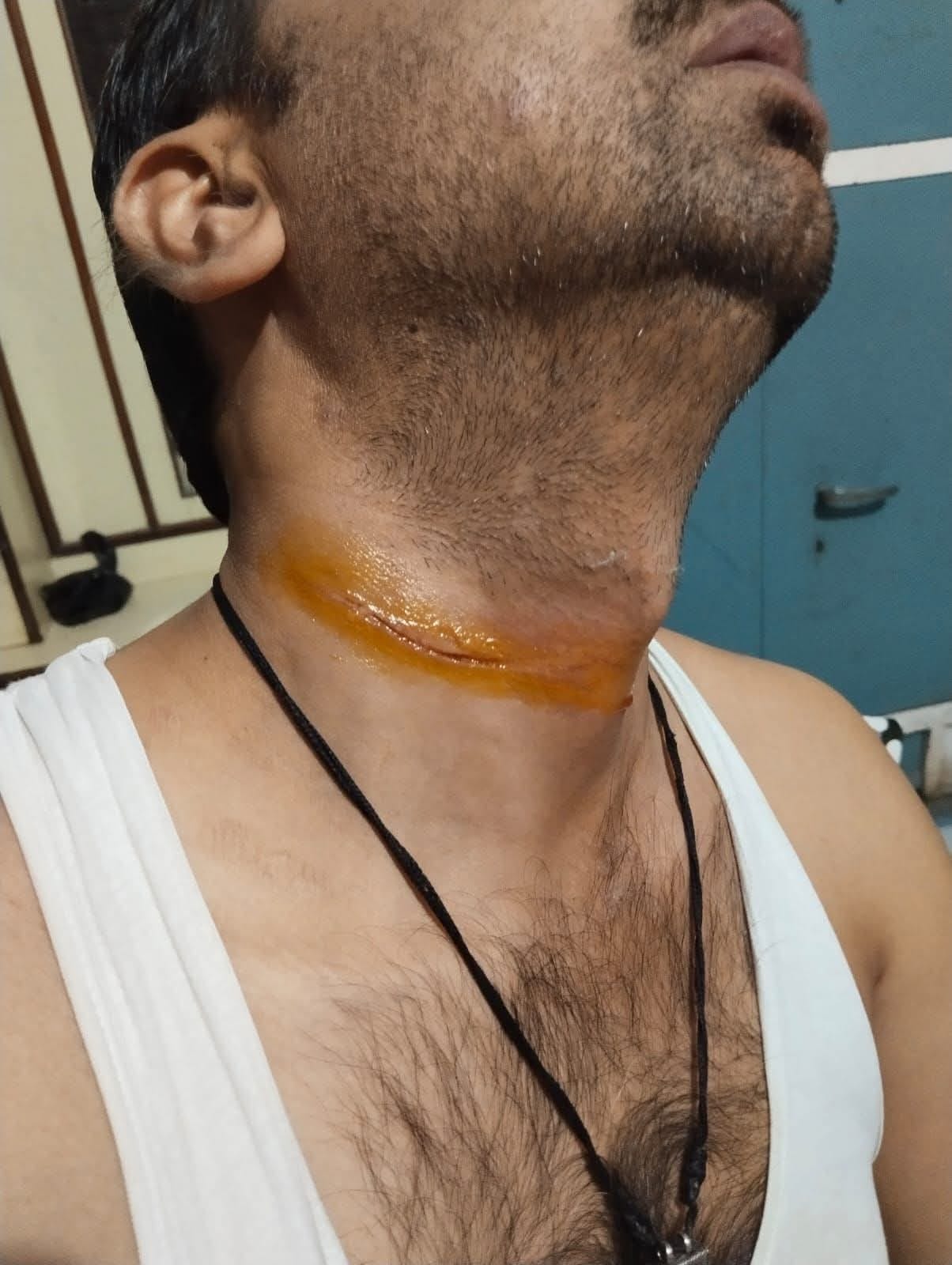 Dangerous manja stuck in the neck, finance worker injured