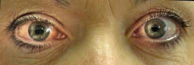 World Glaucoma Week begins, free eye check-up available