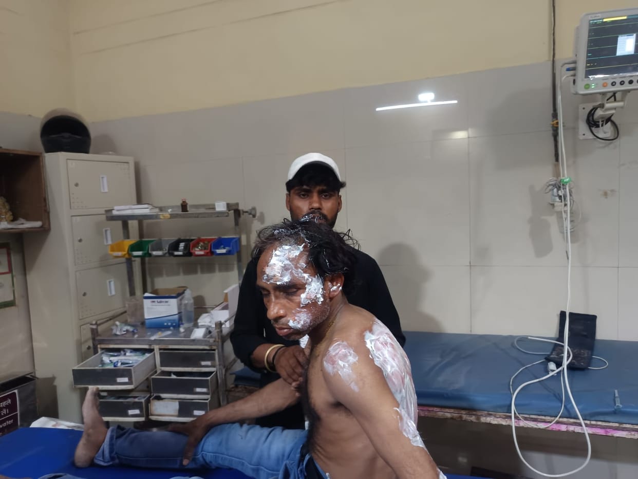 firozabad news labour burned
