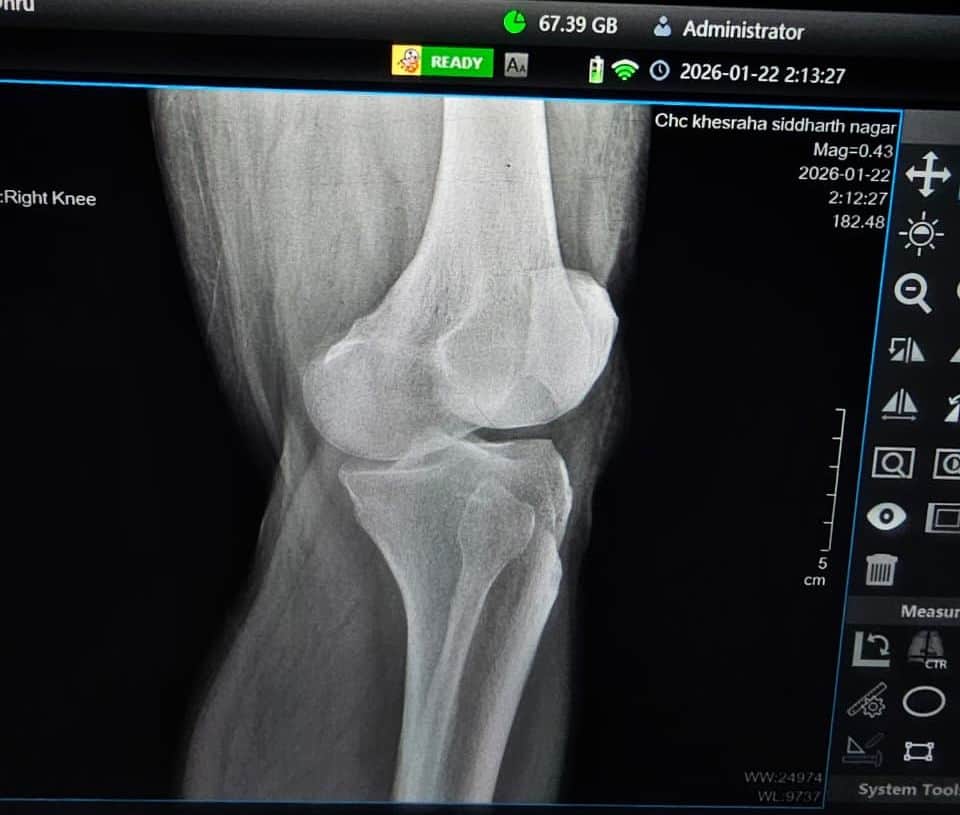 खेसरहा सीएचसी पर शिक्षक विधायक धुव्र कुमार त्रिपाठी काे एक्स-रे प्लेट की जगह फोन में फोटो खींचक