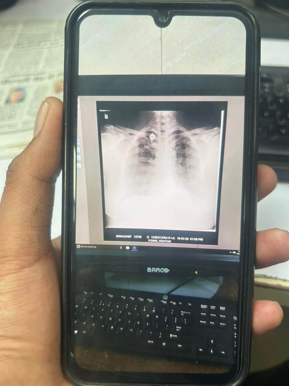 25-पीजीआई में मरीज की एक्स-रे फिल्म का फोन में खींची गई फोटो। संवाद