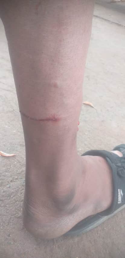 Six people, including children, injured in stray dog terror in Amarwadapanic in the city