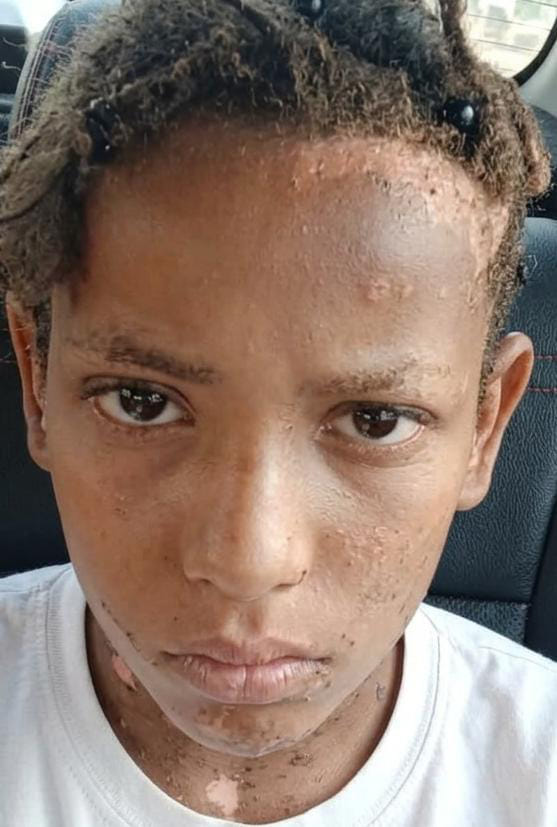 Girl scorched by high-tension line current succumbs during treatment.