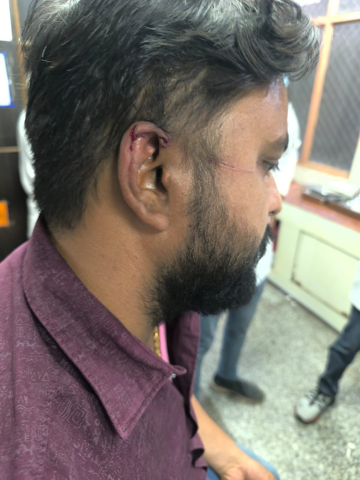 Revenue inspector and BJP leader injured after being entangled in manjha