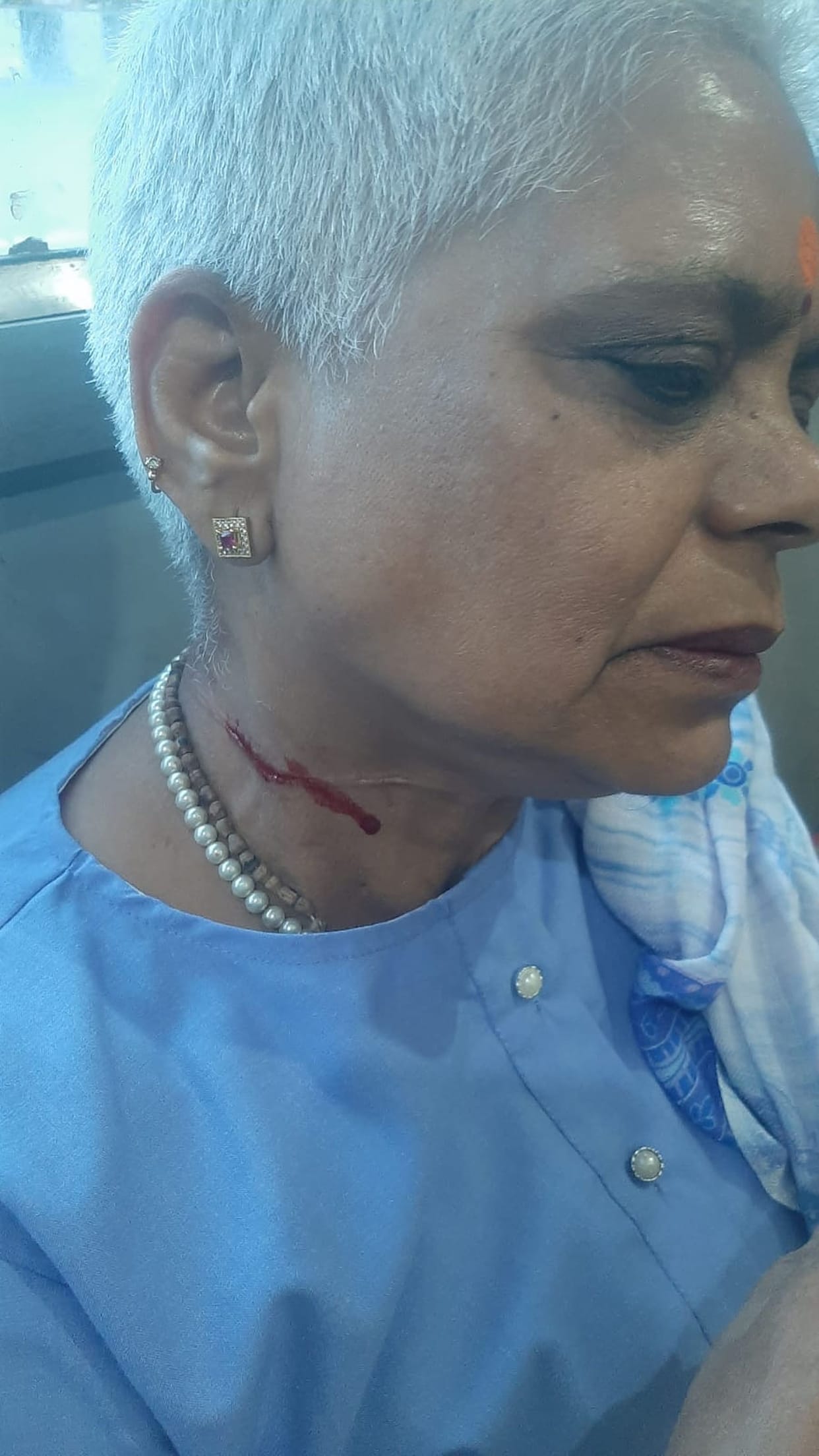 Woman Injured by Chinese Kite String; Neck Slashed