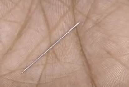 Bihar News: Newborn Suffers Due to ANM Negligence, Broken Needle Stuck in Thigh; Family Struggle for Treatment