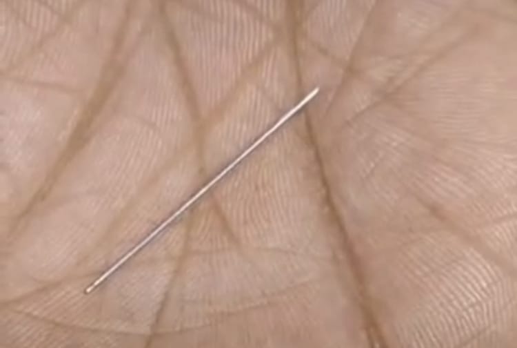 Bihar News: एएनएम की लापरवाही से नवजात की जांघ में फंसी टूटी नीडल, इलाज के लिए भटकते रहे परिजन