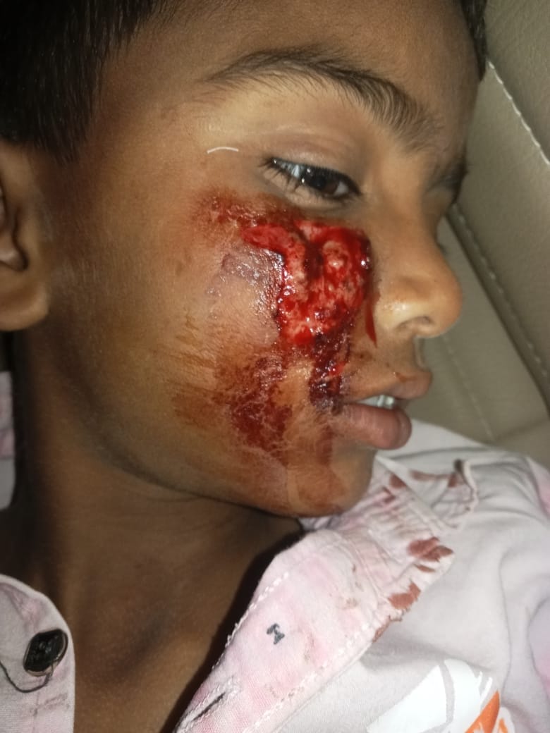The dog attacked and bit the innocent child in several places, and he was admitted to the trauma center.