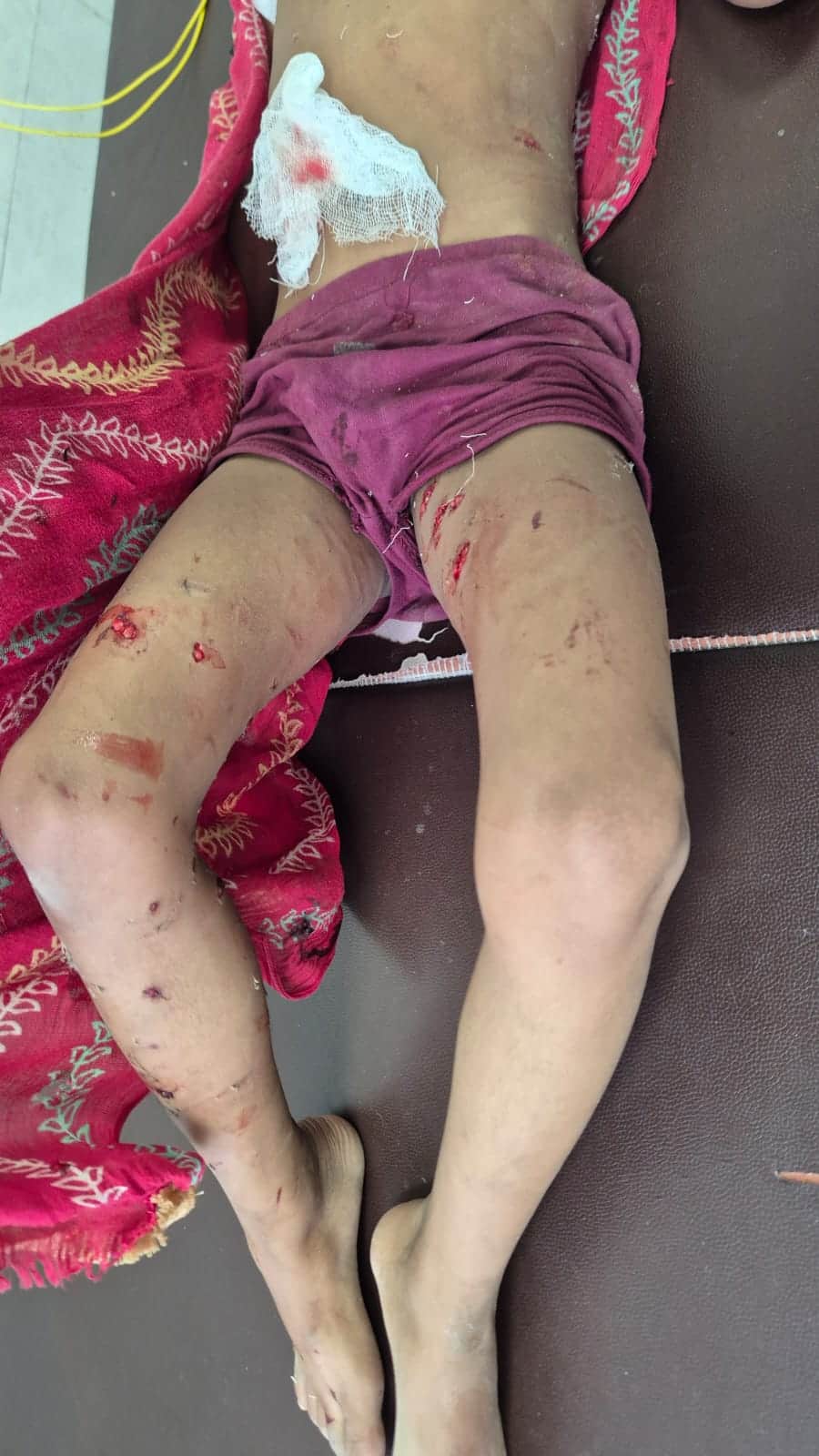 घायल के शरीर पर कुत्तों के काटने के निशान।