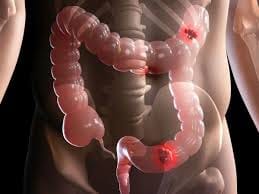 People are not aware of colon cancer.