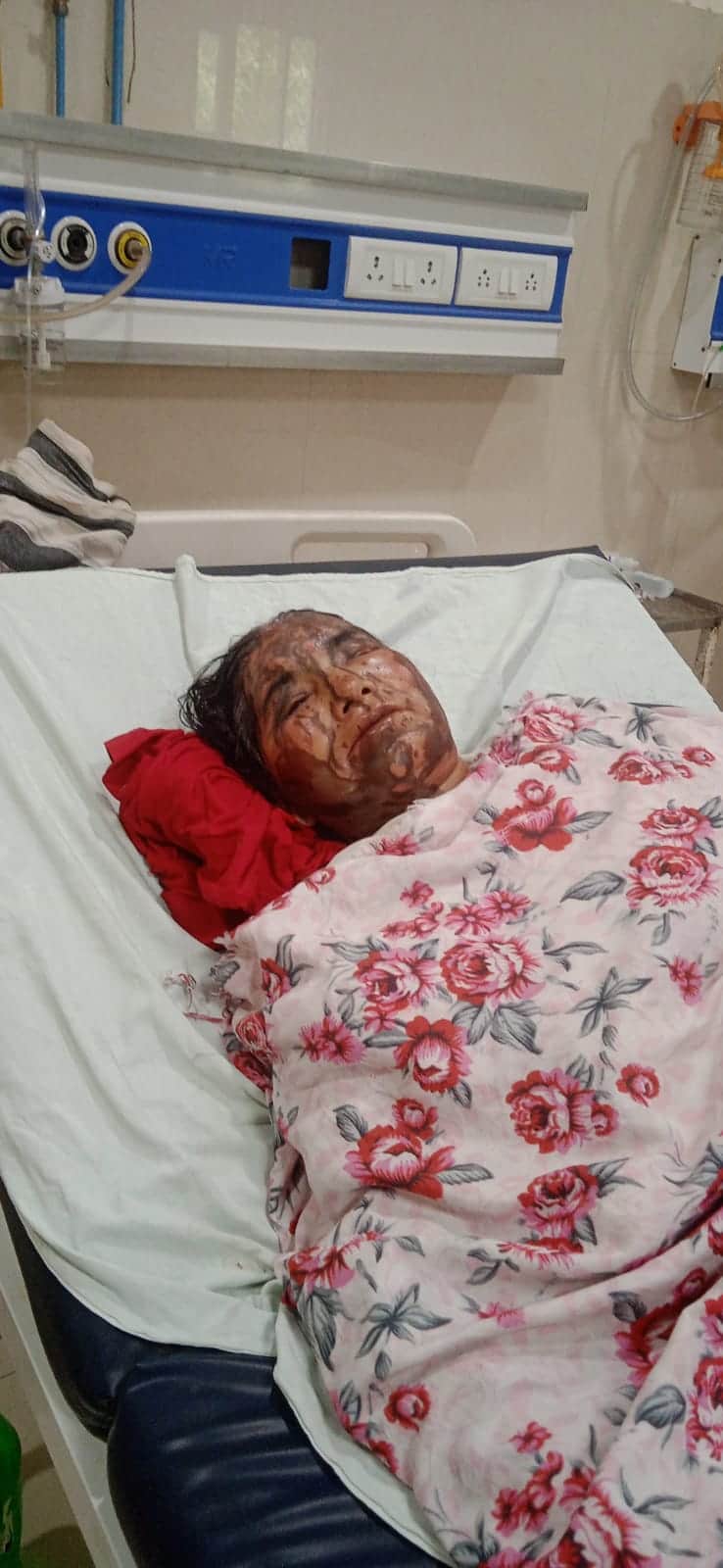 रामकोला थाना क्षेत्र के मोरवन इमिलिया टोला में एसिड से किए गए हमले में घायल लिलावती देवी की मेड