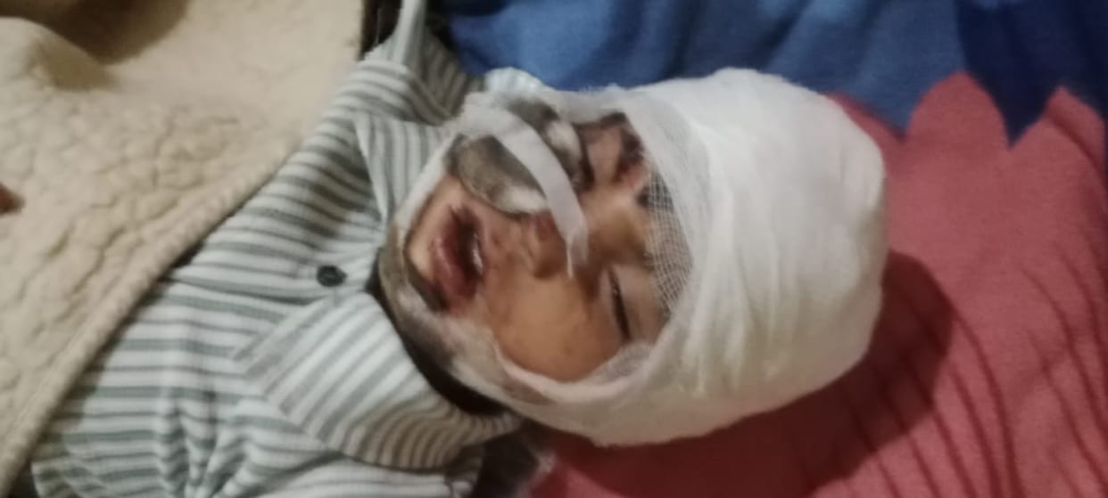 Four-Year-Old Child Critically Injured in Dog Attack; Requires 35 Stitches