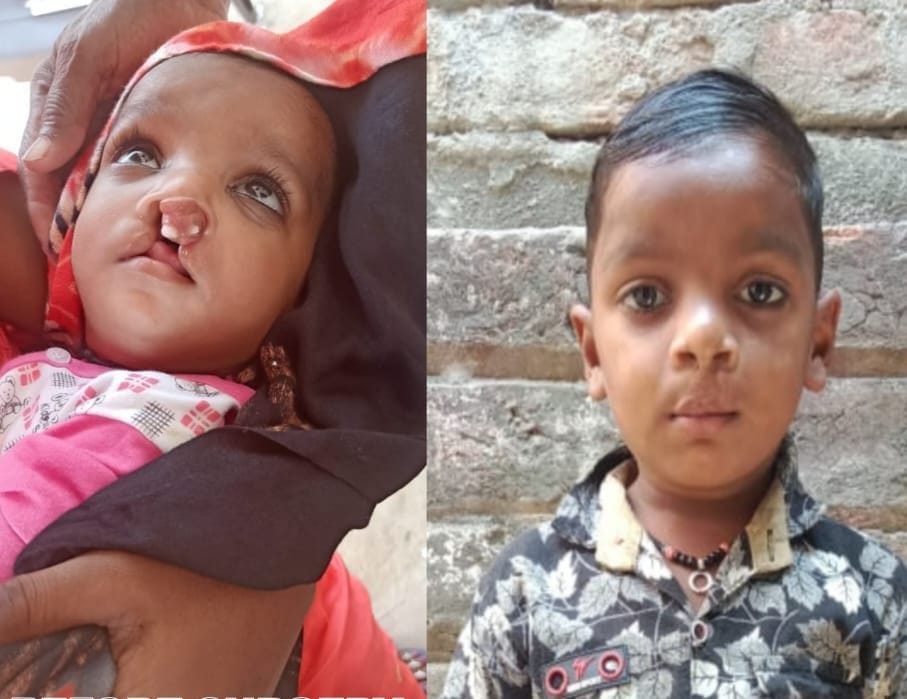 In three years, smiles returned to the faces of 103 children, life changed through surgery