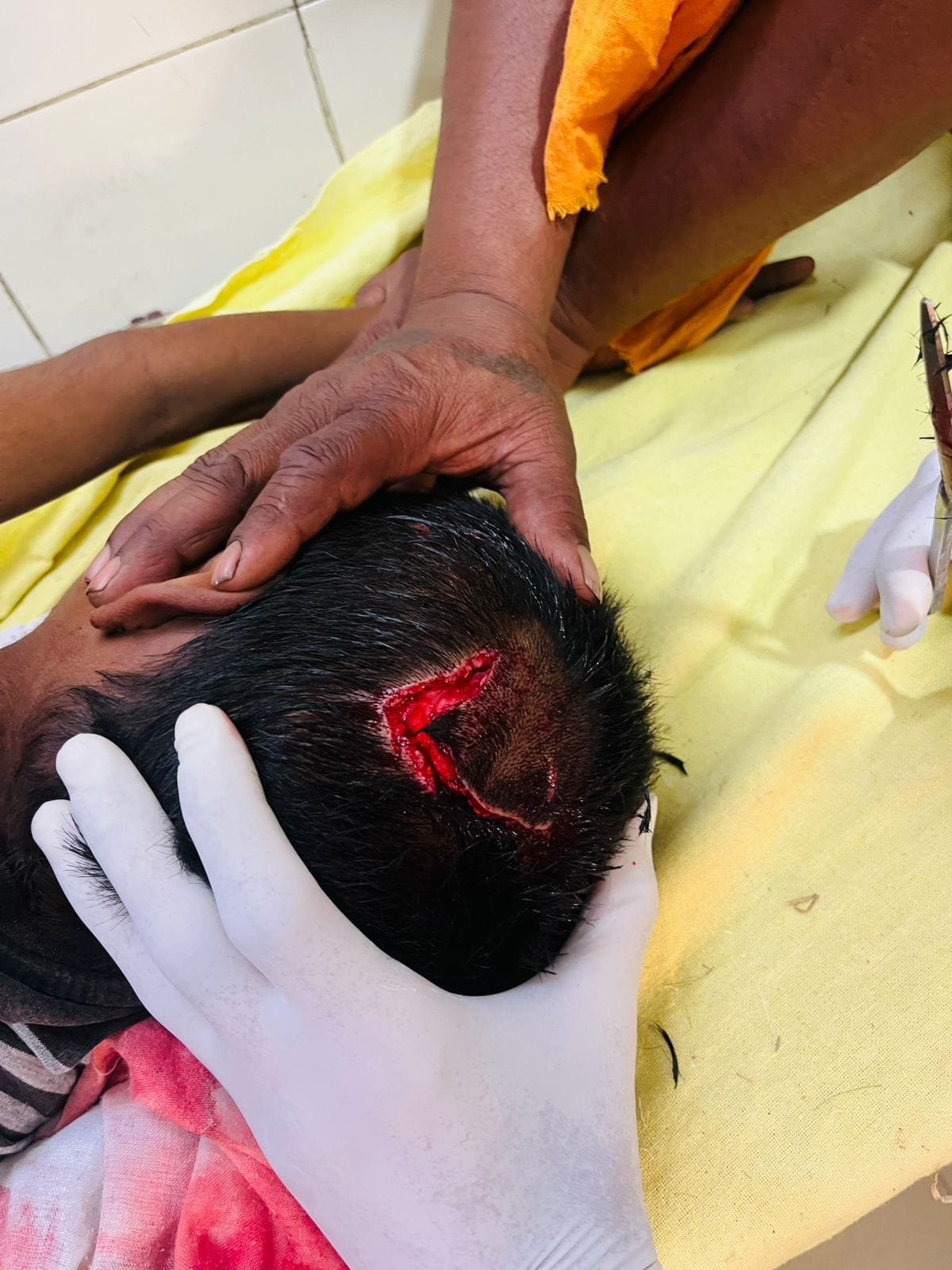 The terror of monkeys... 9-year-old boy attacked, 8 stitches in the head