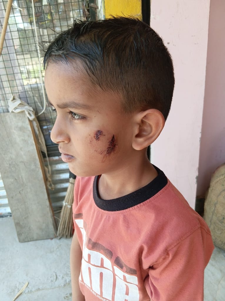 A seven-year-old boy playing in a field was attacked by stray dogs.