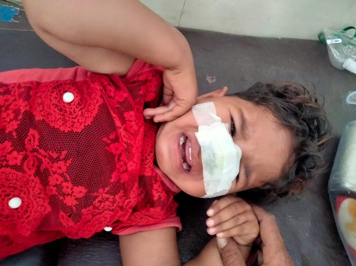 Dog pounces on girl, bites her nose, condition critical