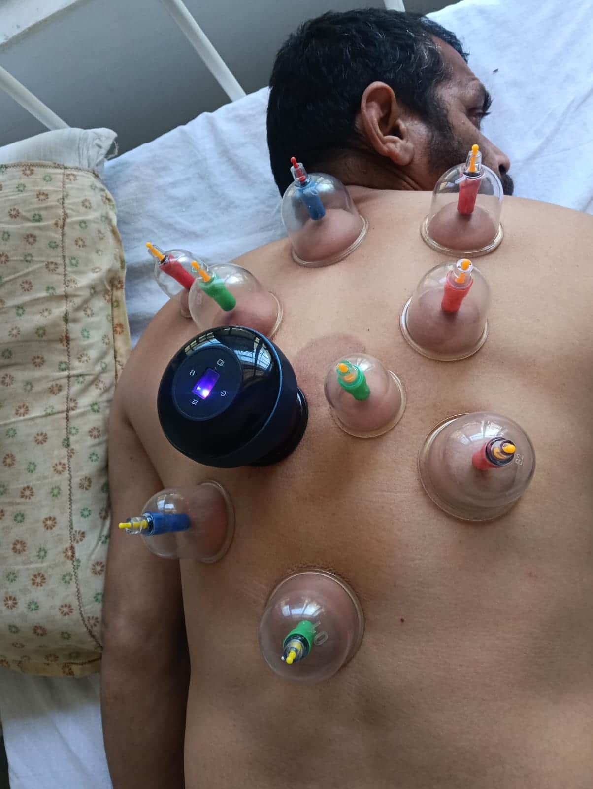 आयुर्वेदिक अस्पताल में कपिंग थेरेपी से मरीज का इलाज। स्रोत : आयुर्वेदिक विभाग