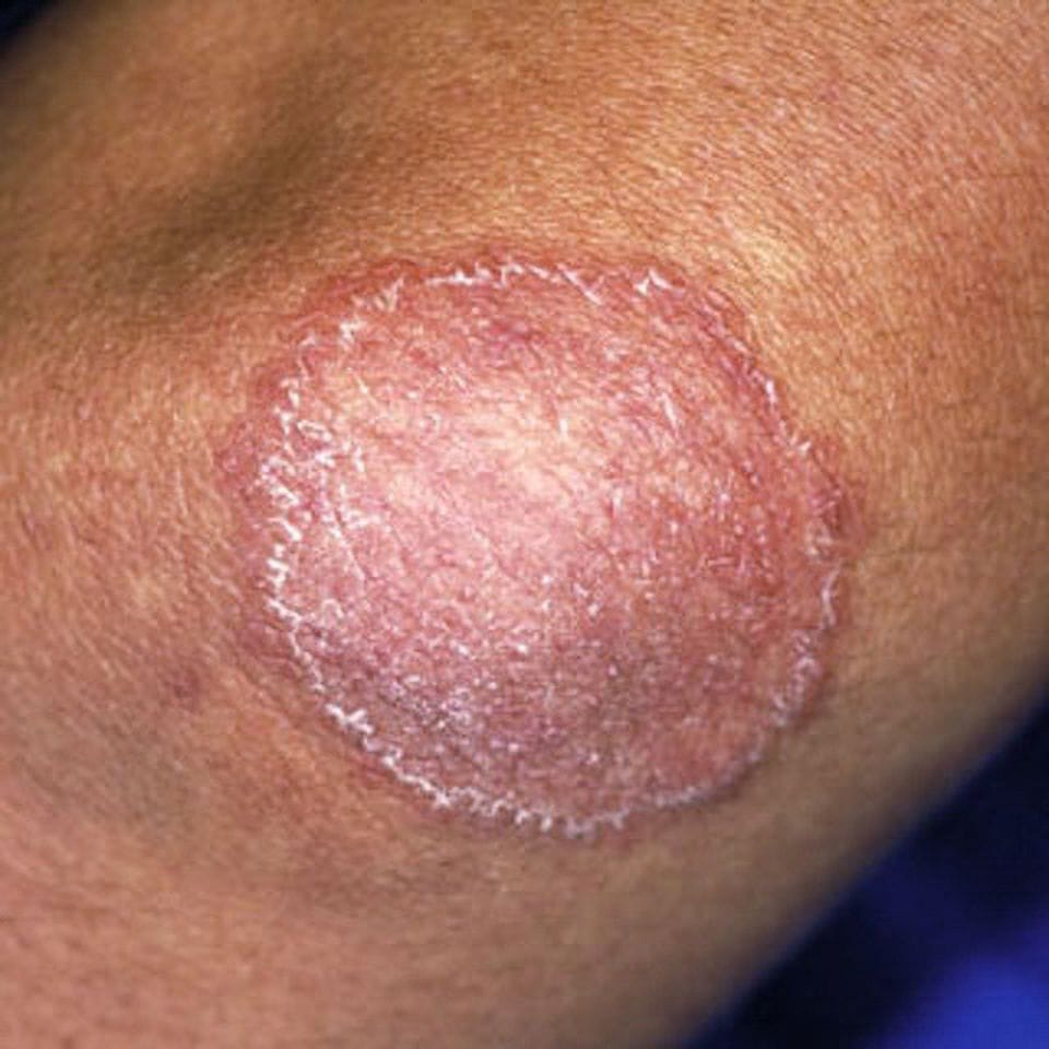 The risk of fungal infection may increase in summer
