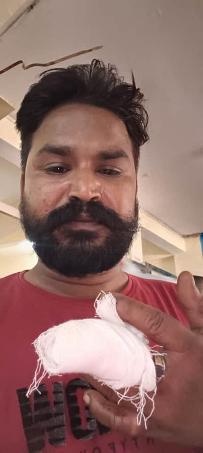 Birthday fight: Young man bites his cousin's finger