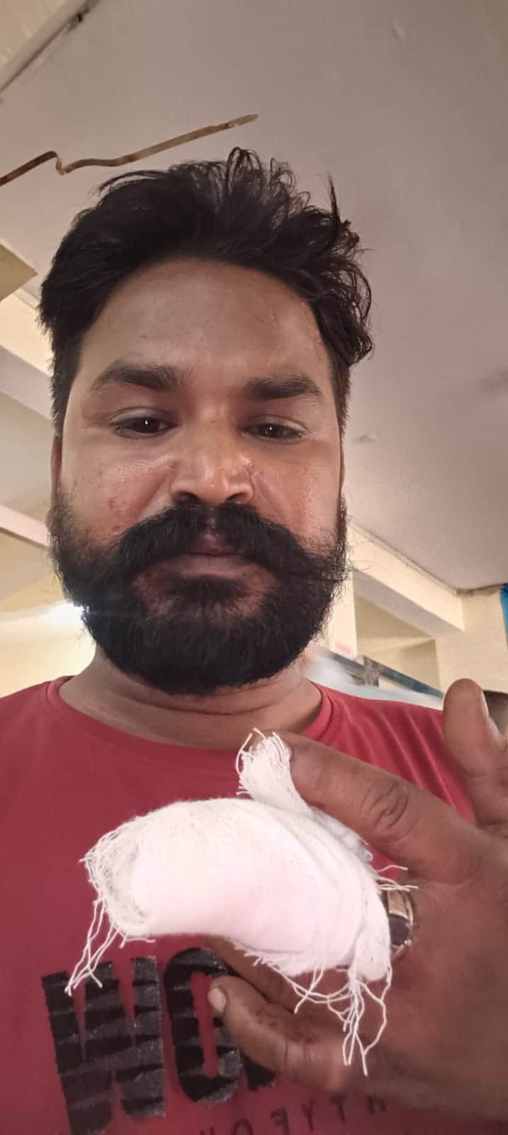 भाई ने भाई की उंगली को चबाया