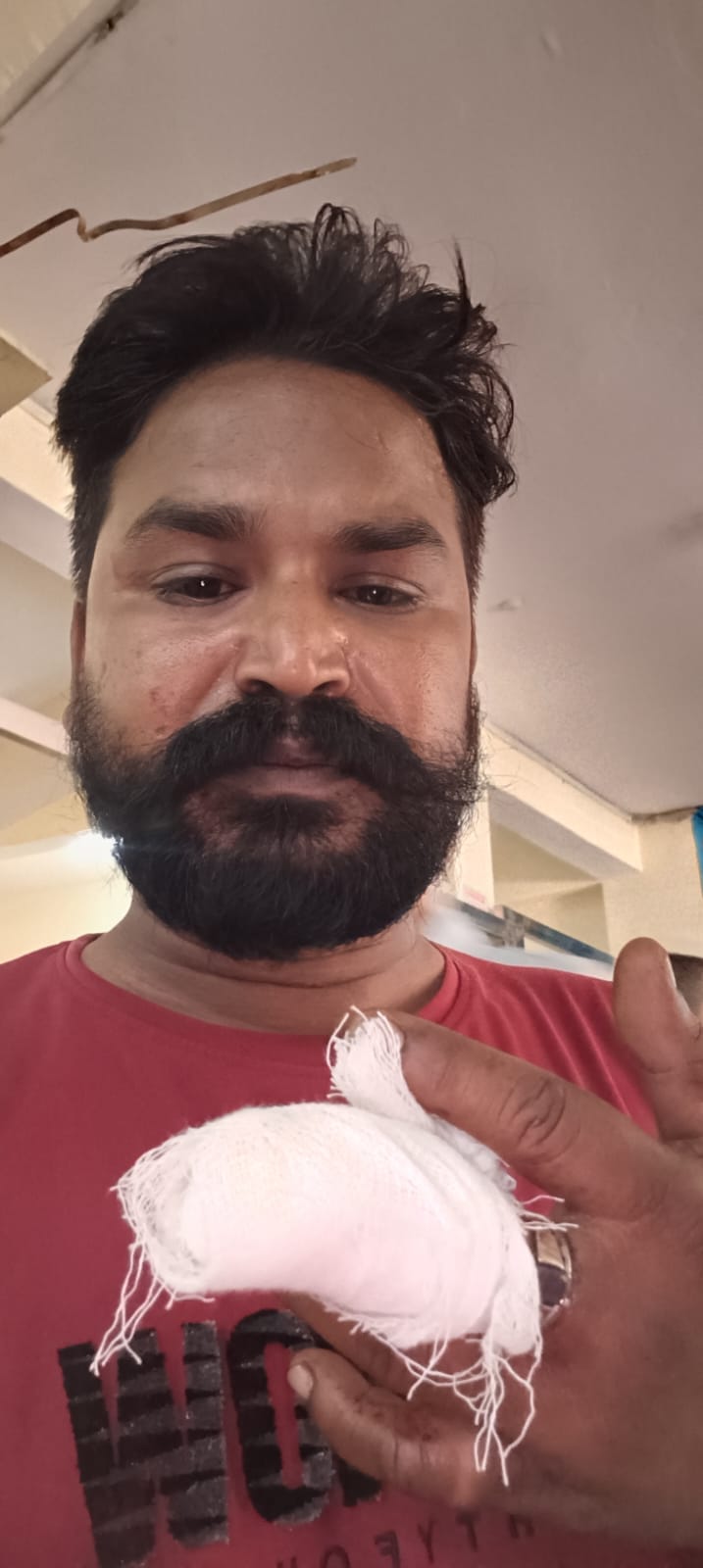 भाई ने भाई की उंगली को चबाया
