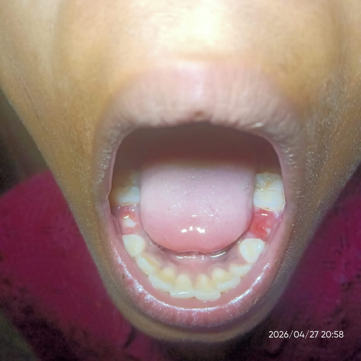 Students fight over bus seat, child loses tooth