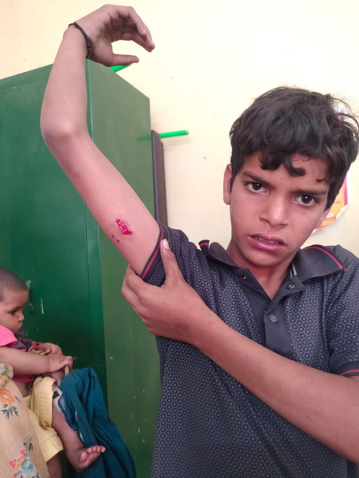 Two brothers attacked by stray dog, one seriously injured