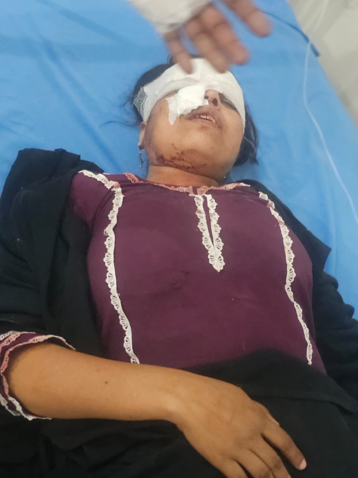 Couple on Bike Injured in Car Collision