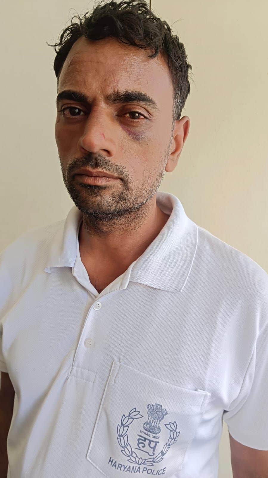 फोटो नंबर-05आंख पर चोट के निशान दिखाता पुलिस जवान निलेश। संवाद