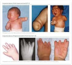 Childhood Blooms After Defeating a Congenital Defect