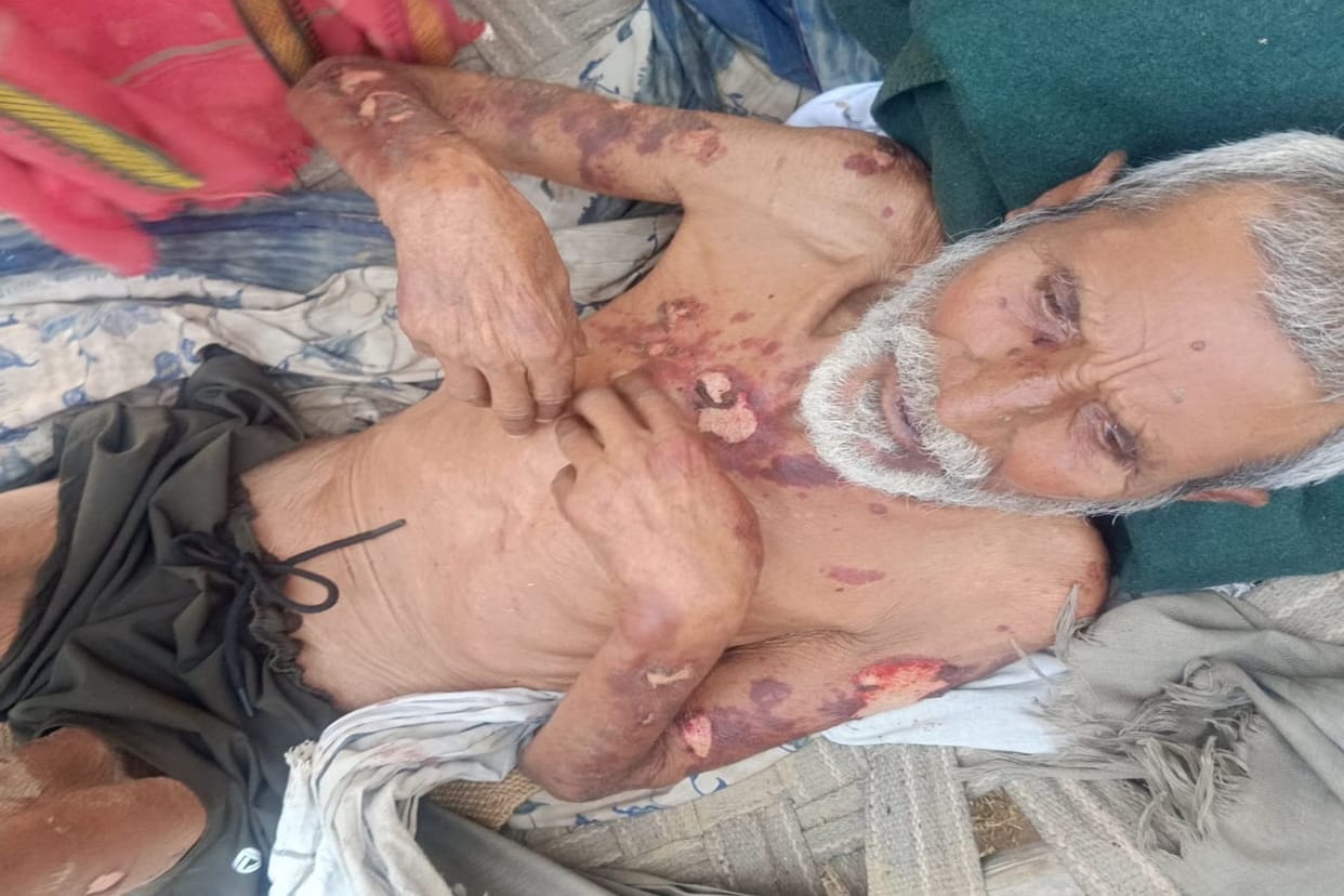 Neighbor pours toilet cleaner on elderly man sleeping in cattle shed