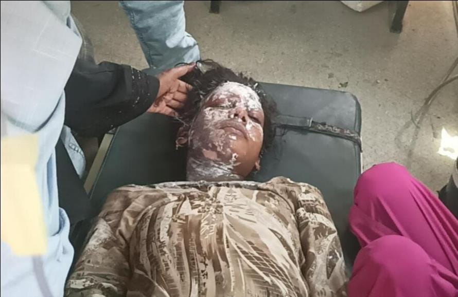 Teenage girl burnt by HT line current