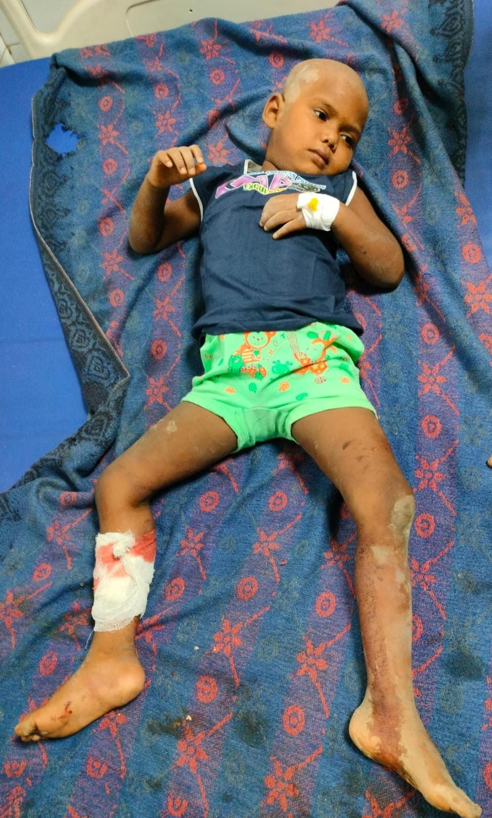 Five-year-old girl injured in dog attack
