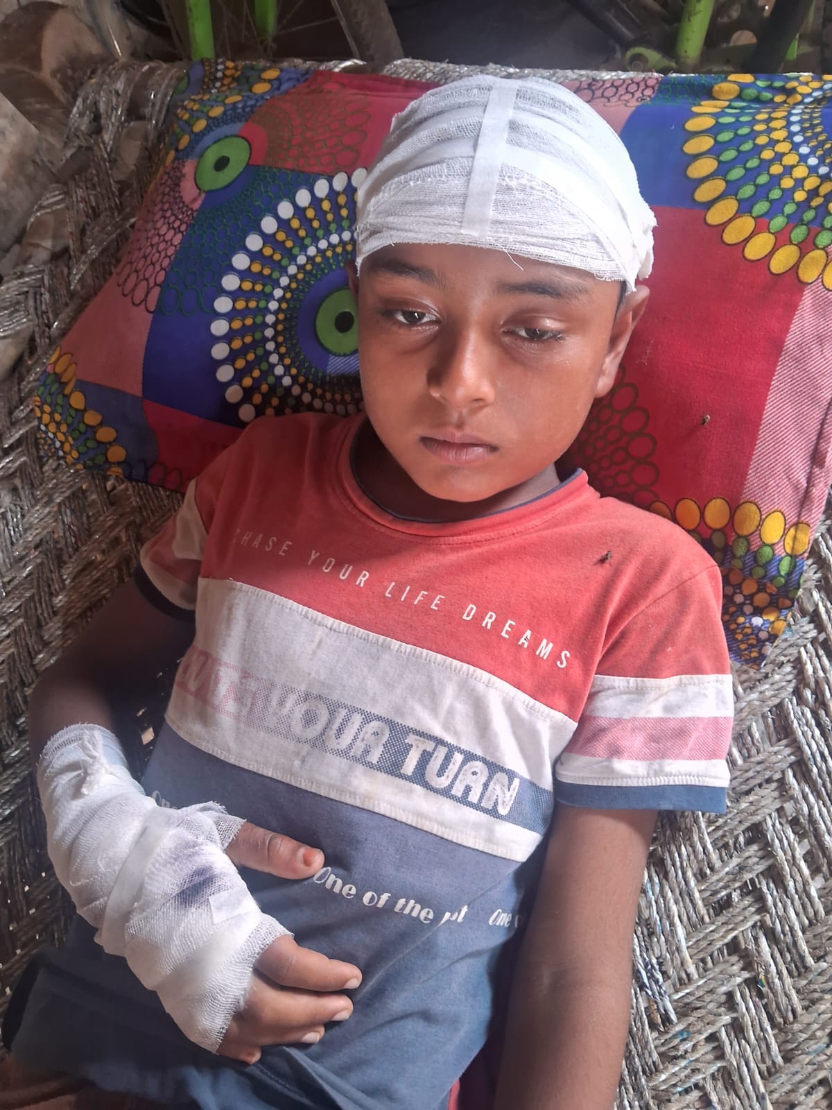 Two boys suffered electric shock burns.