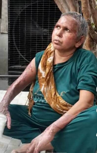 फोटो कैप्शन अग्निकांड फैक्ट्री में घायल महिला रीना।
