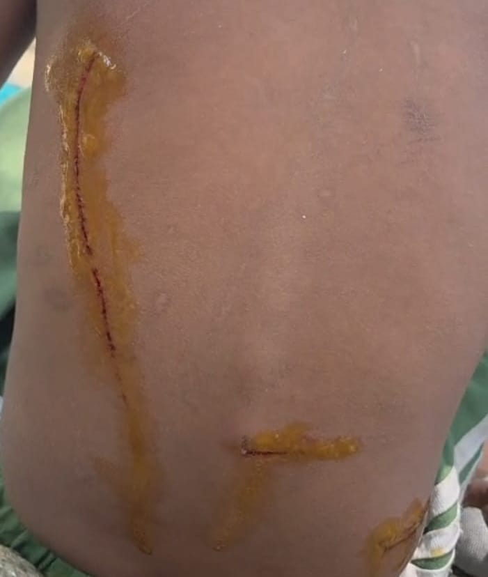 Innocent two-and-a-half-year-old branded with a *bidi* and inflicted with deep wounds in multiple places using a key.