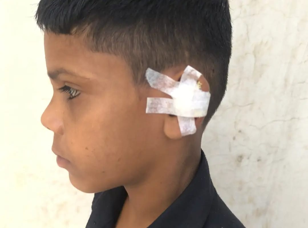 A monkey bit off the ear of an innocent child playing on the roof.