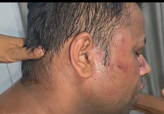 Youth suffers injury to right shoulder and a split finger from a beating.
