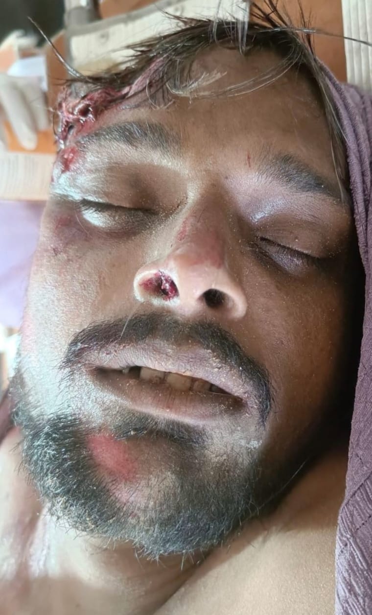 Motorcyclist injured after falling into an incomplete drain in Itwa.