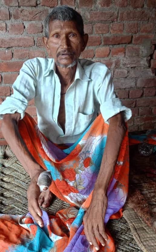 Elderly man bitten by cobra, saved by hospital treatment