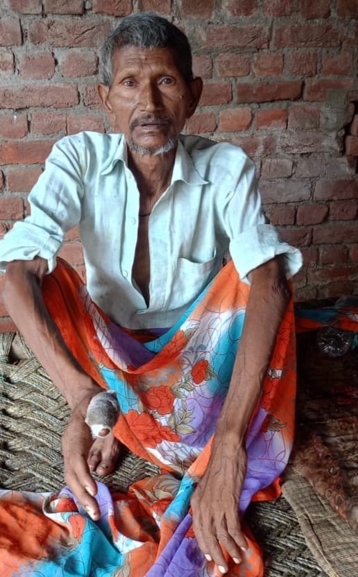 Elderly man bitten by cobra, saved by hospital treatment