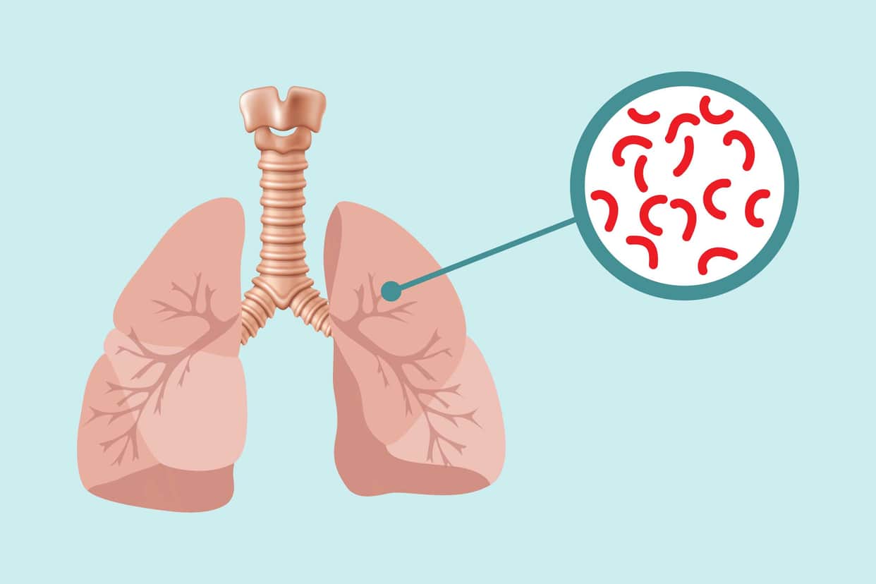 TB Campaign: 9,370 new patients detected during screening of 2.8 lakh people.
