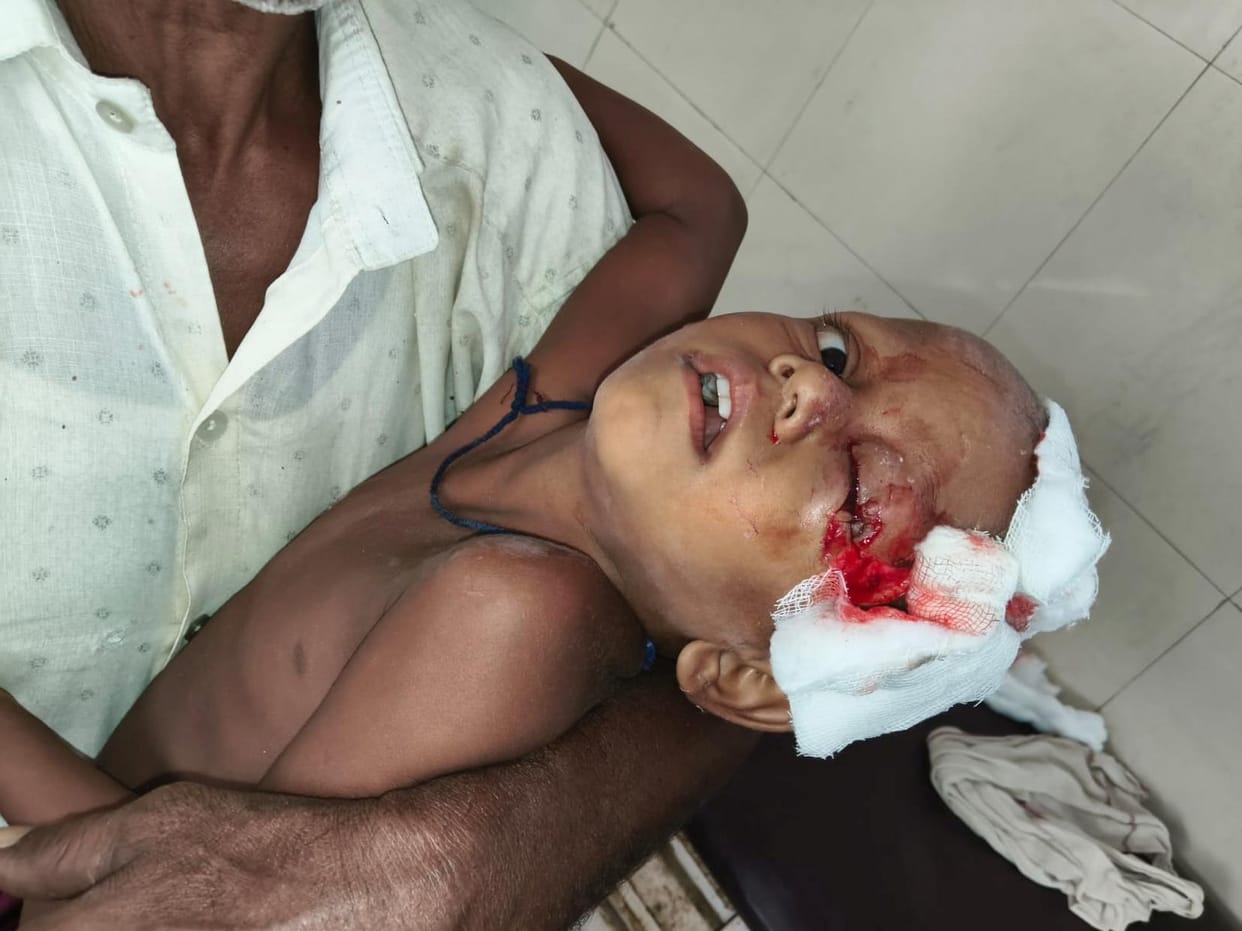Girl injured in dog attack; condition critical.