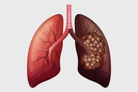 Don't spread smoke, kindle hope; protect your lungs from cancer.