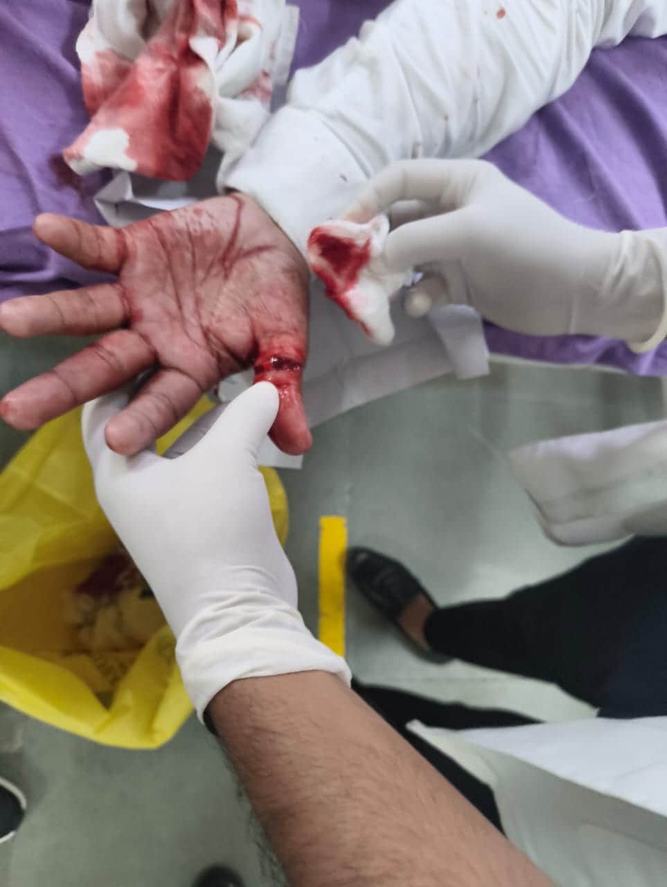Two lawyer brothers injured by Chinese manjha in Narnaul.