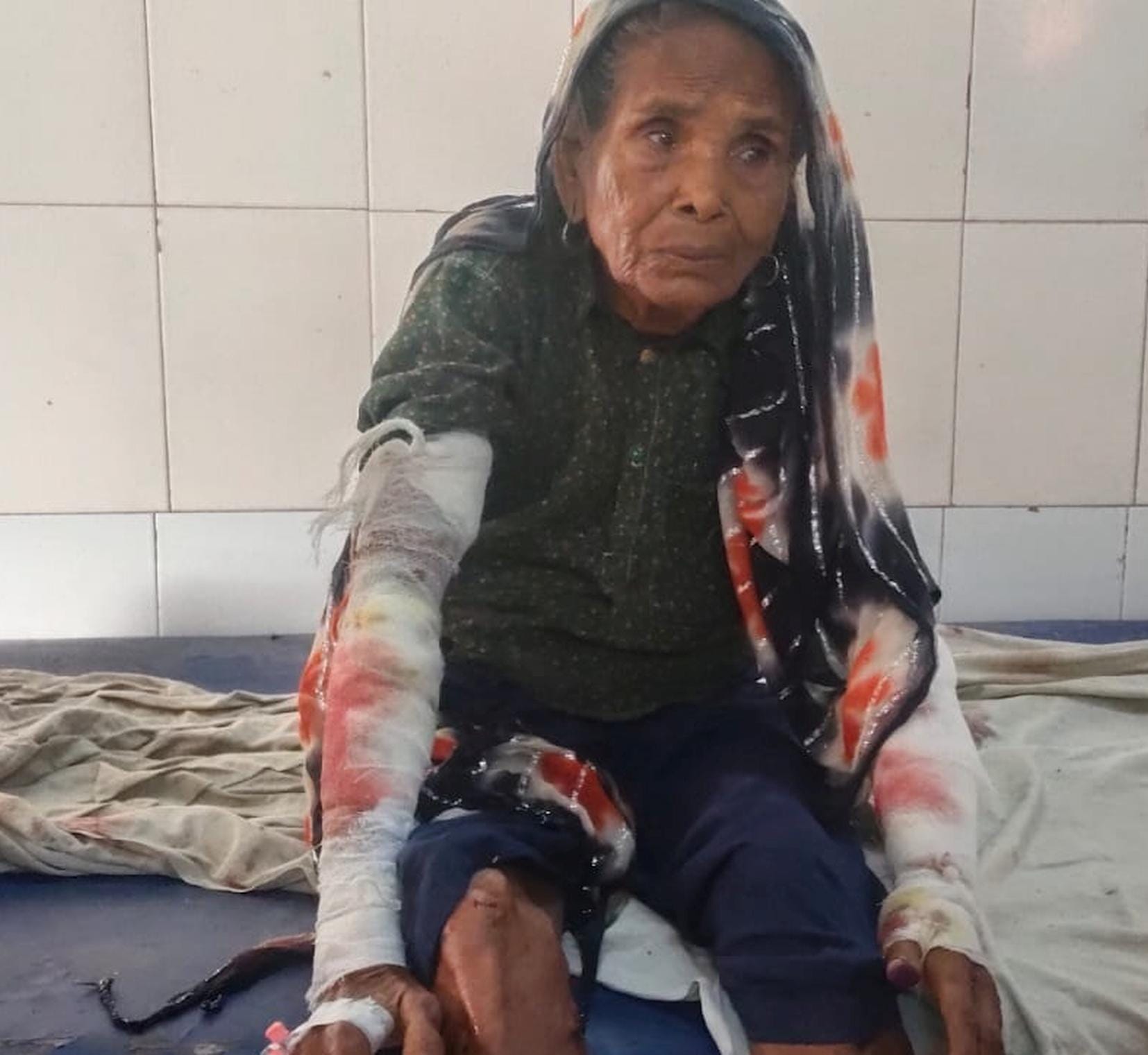 राजापुर गिरंट में तेंदुए के हमले में घायल वृद्धा जयकाला। 
