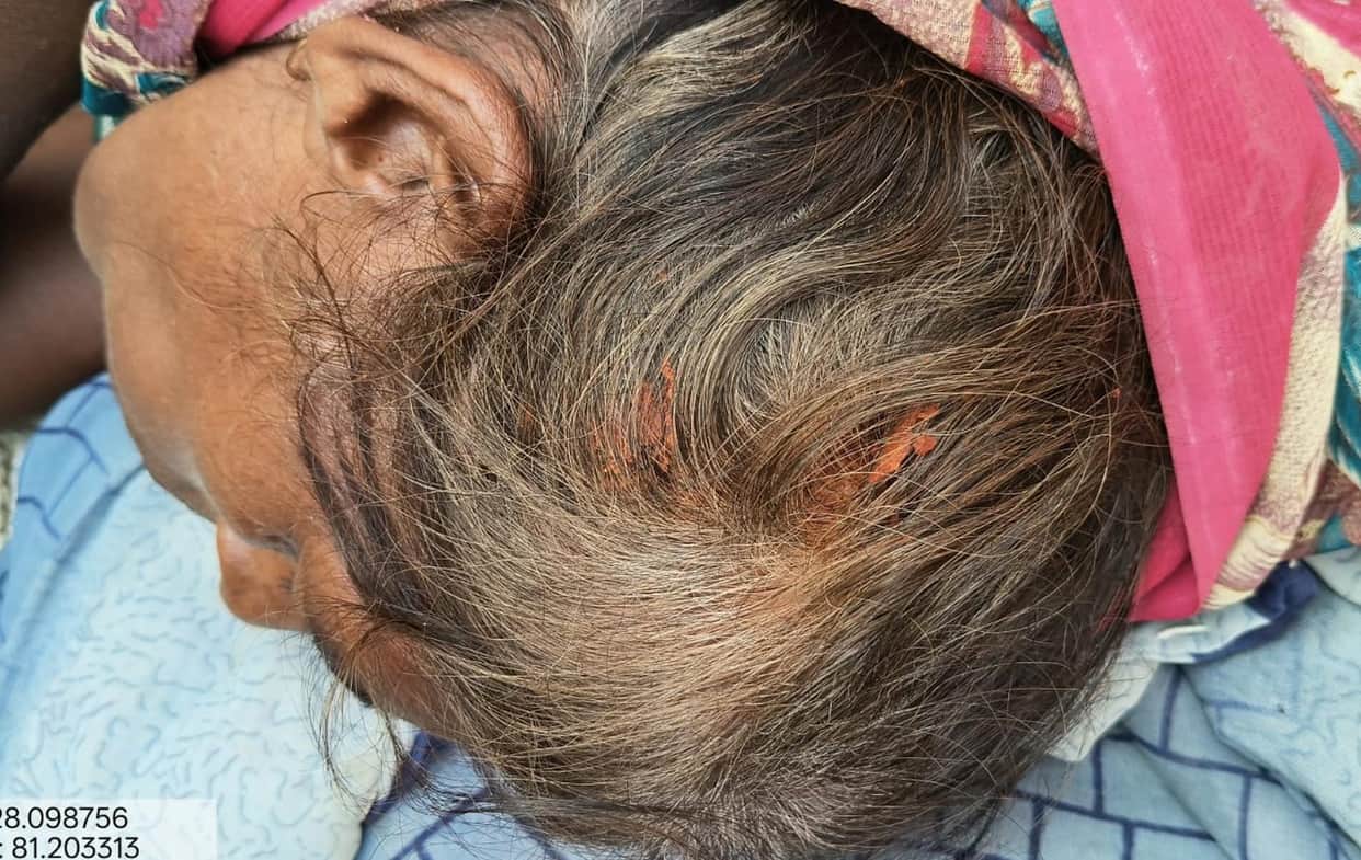 Leopard attacks woman sleeping on veranda; sustains deep head wounds.