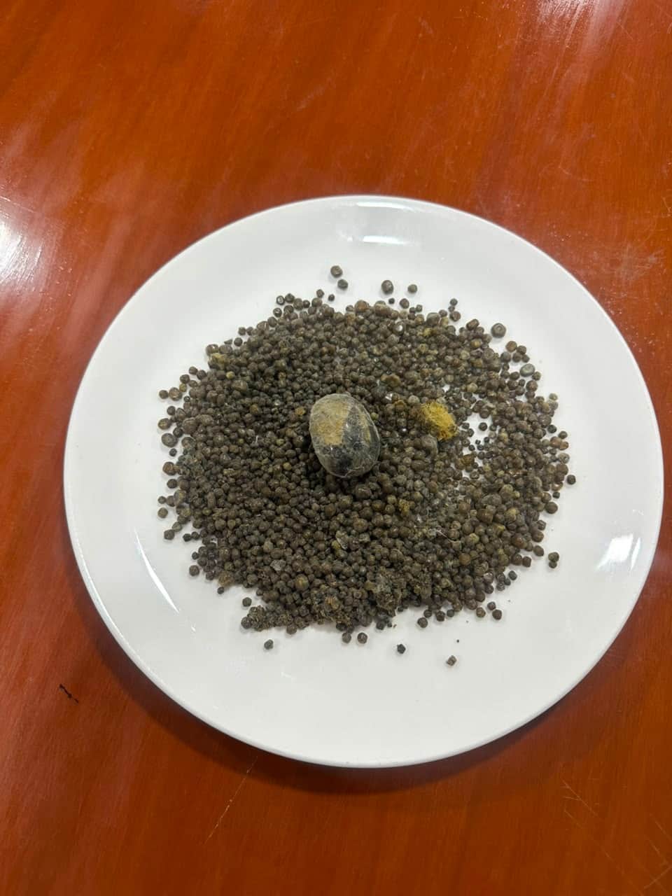 Over 4,000 stones removed from patient's gallbladder.