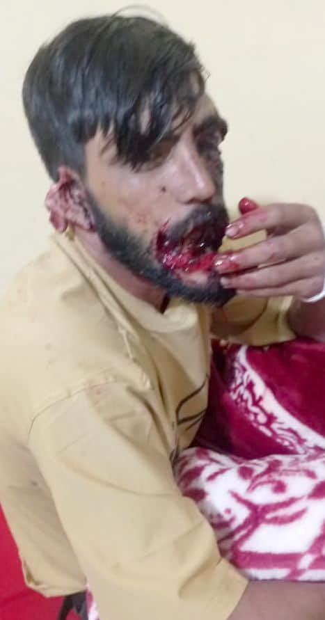 Bear attacks and seriously injures youth in Badhal forest